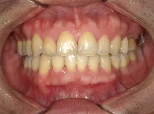 【After】成人ワイヤー矯正