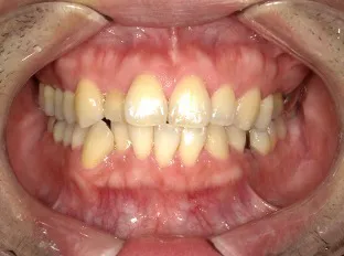 【Before】成人ワイヤー矯正