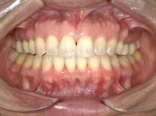 【After】マウスピース型矯正