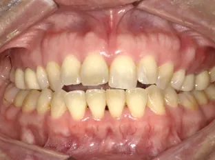 【Before】マウスピース型矯正