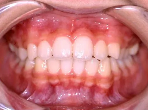 【After】小児矯正