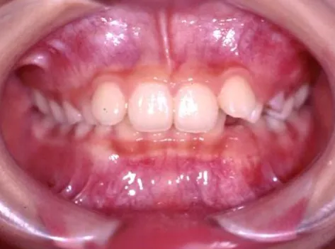 【Before】小児矯正